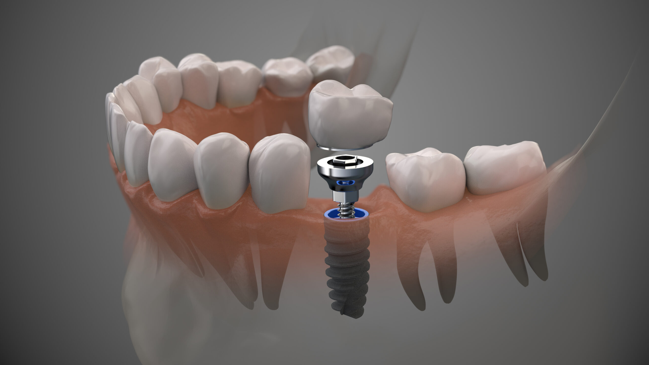Computer-Generated Graphic of Human Lower Jaw with Transparent Gums Showing Teeth Down to Roots and Dental Implant