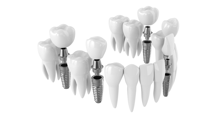 Stock Image of Dental Implants Isolated on White Background