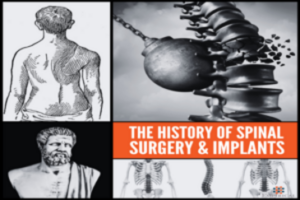 The History of Spinal Surgery and Implants