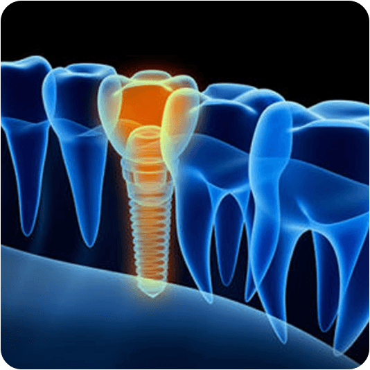 3D Graphic of an X-Rayed Dental Implant