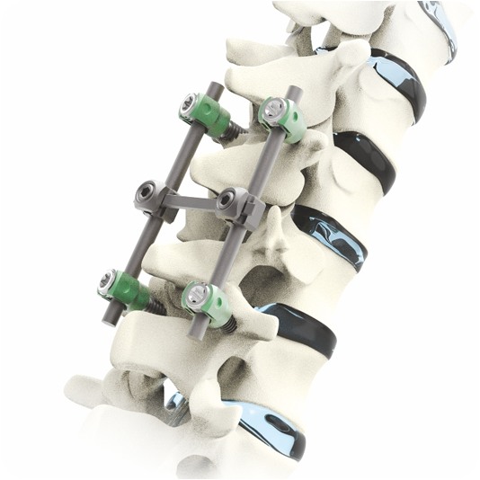 Spinal Prosthesis