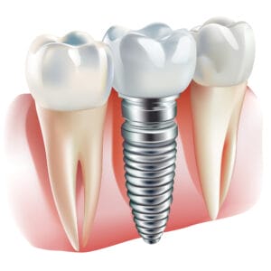 tooth implant